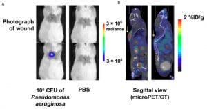 New PET Tracer Can Identify Bacterial Infections