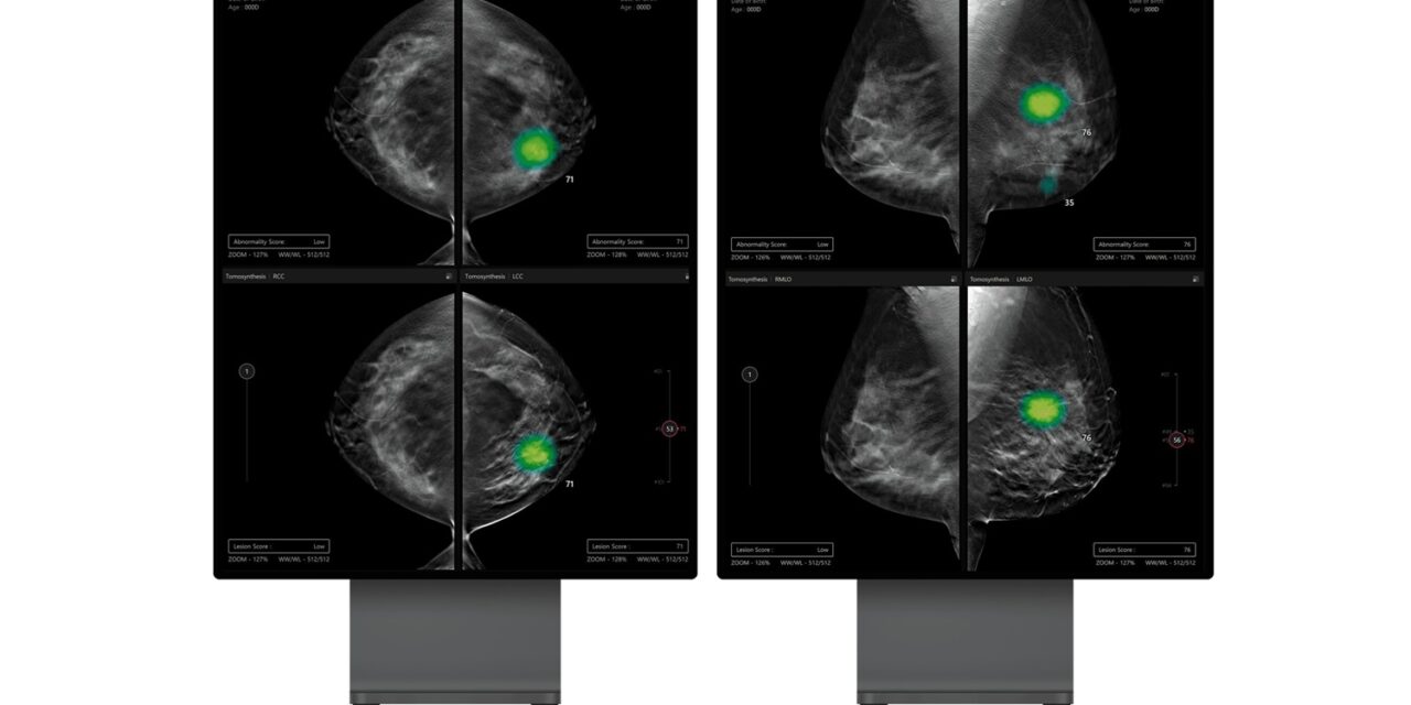 SimonMed Imaging Partners with Lunit for AI for Breast Cancer Detection