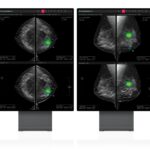 SimonMed Imaging Partners with Lunit for AI for Breast Cancer Detection