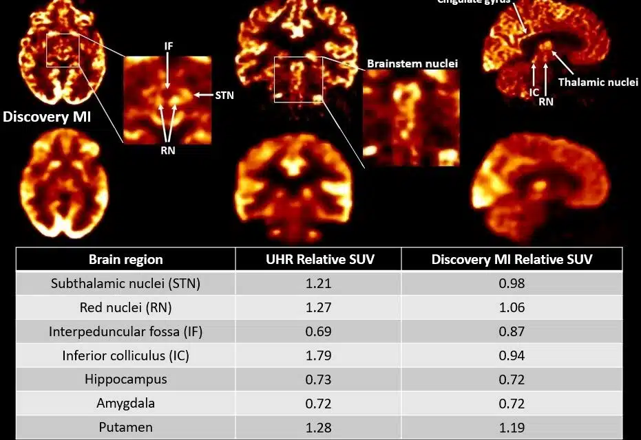 Siemens Healthineers Debuts Biograph Vision.X PET/CT Scanner